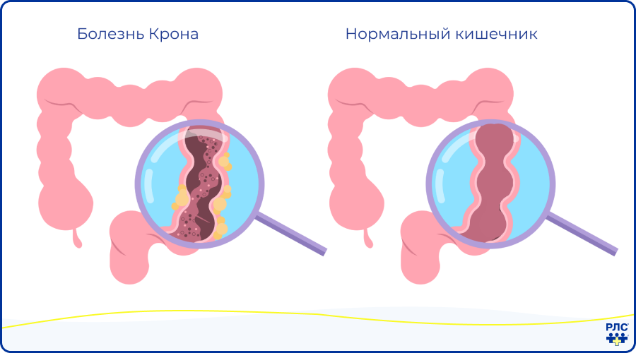 Тяжесть болезни крона. Заболевание кишечника крона. Болезнь крона илеоколит.