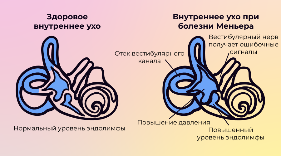 Болезнь меньера клинические