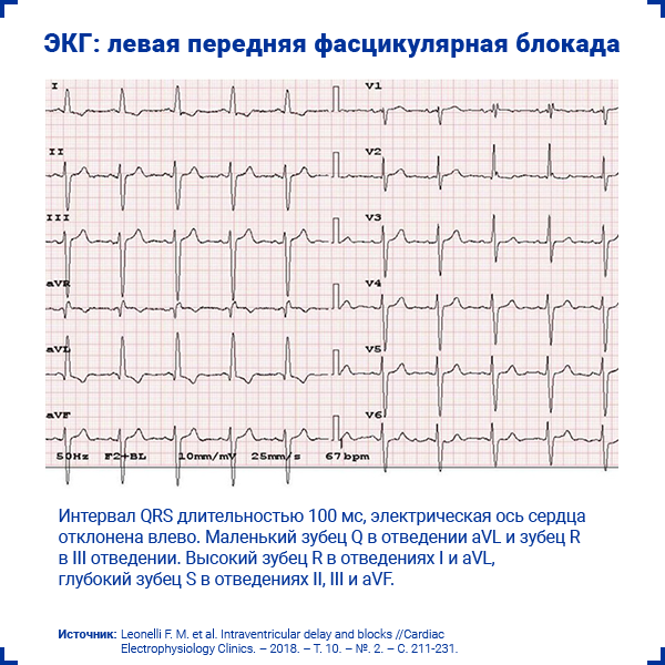 БЛНПГ на ЭКГ. Блокады на ЭКГ. Фасцикулярная блокада. Критерии Сгарбосса ЭКГ.