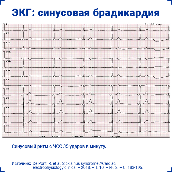 Синдром слабости синусового узла код мкб 10. Синдром слабости синусового узла карта вызова СМП.