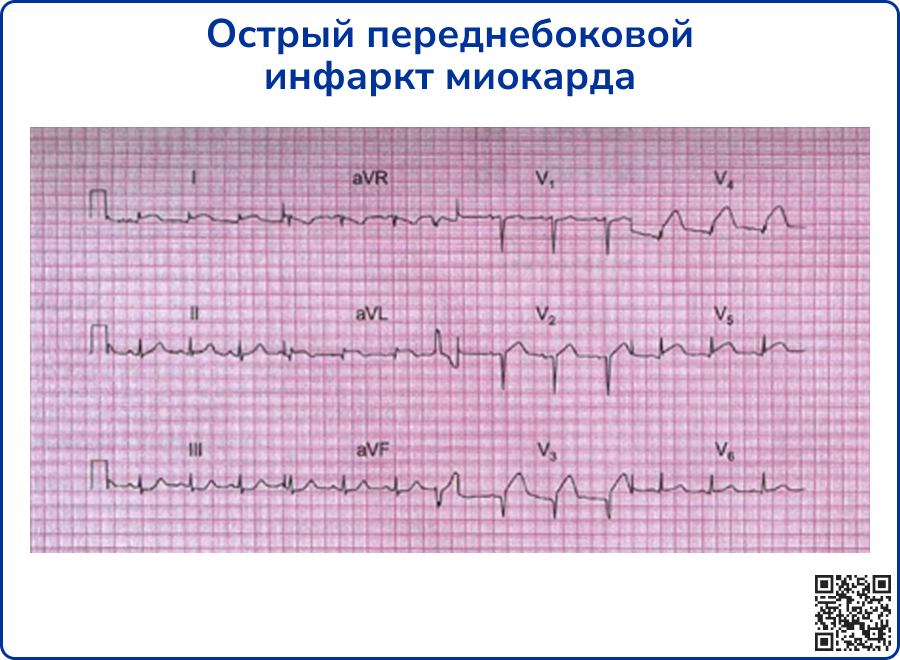 Оим нижней стенки мкб 10