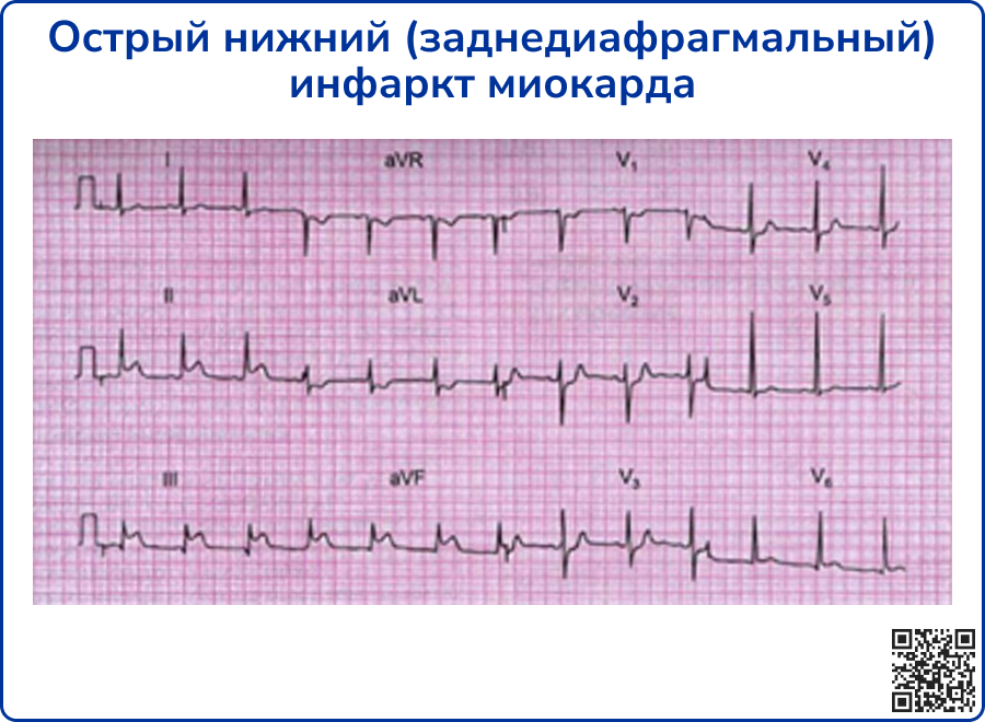 Ишемия нижней стенки на экг